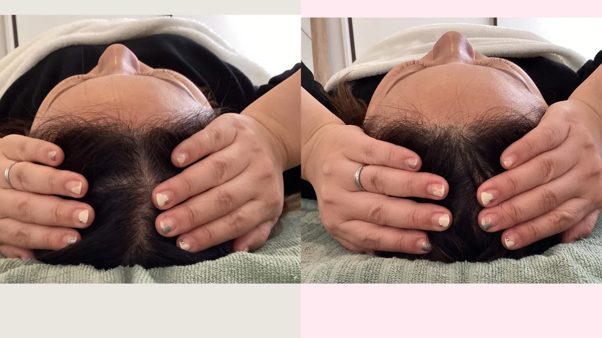 ✨小顔矯正 Before → After✨