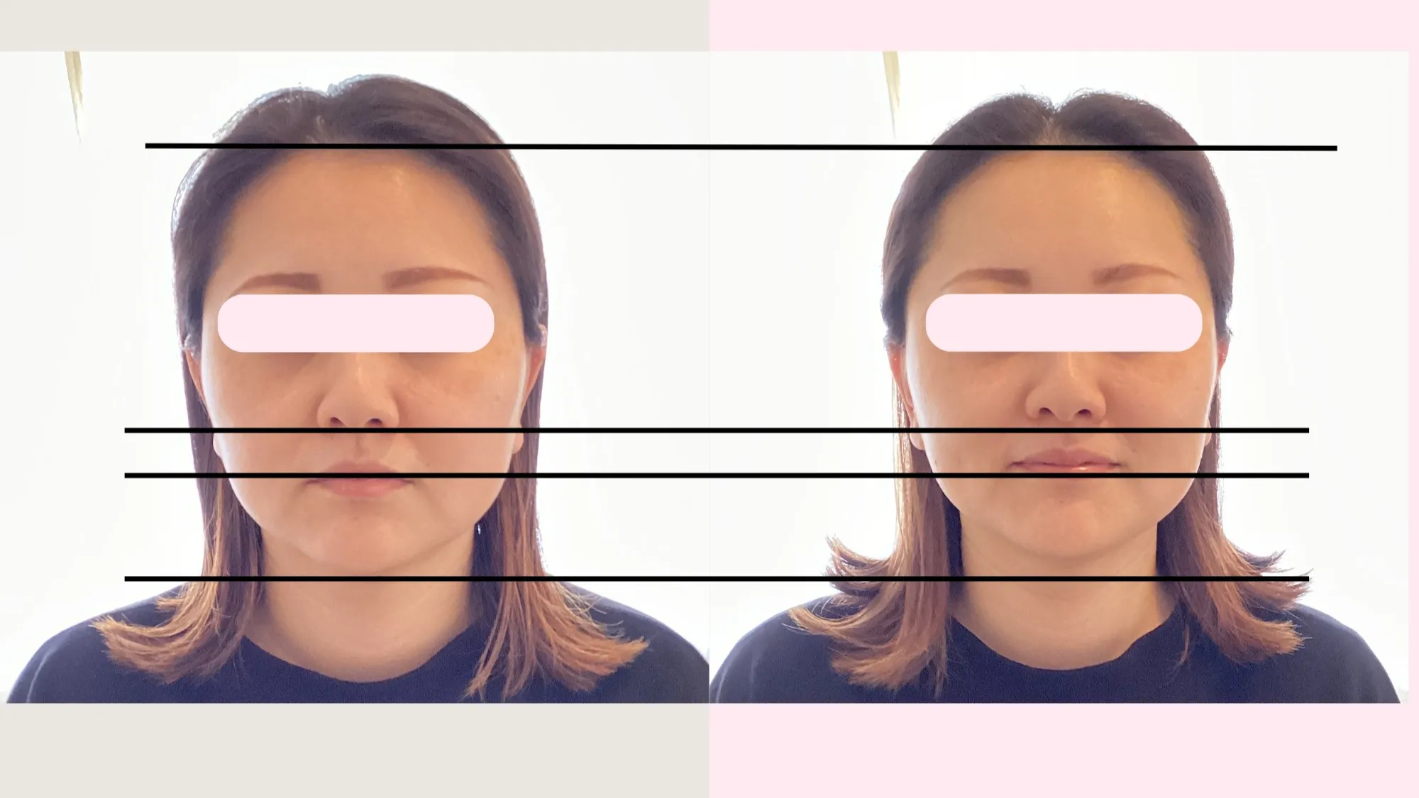 ✨小顔矯正 Before → After✨