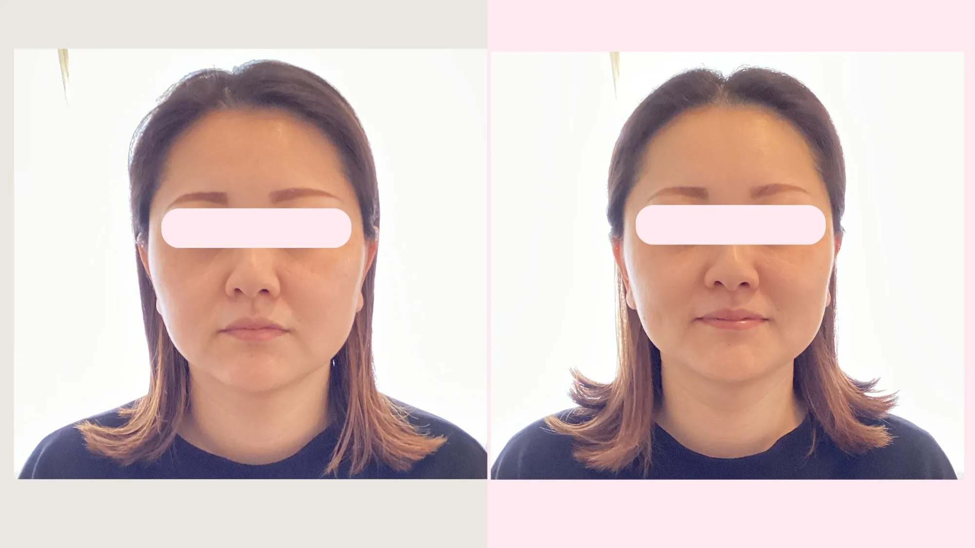 ✨小顔矯正 Before → After✨